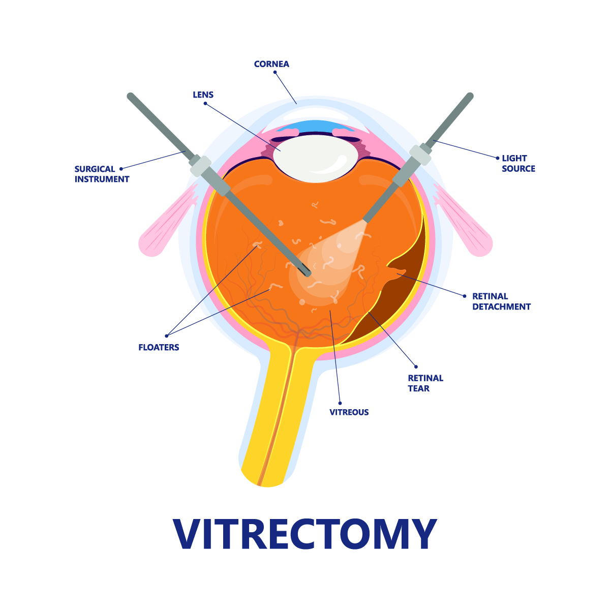 Retina Surgery